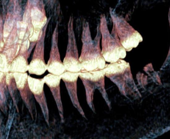 Xray of the jaw of the Pazyryk mummy found to have had jaw surgery.