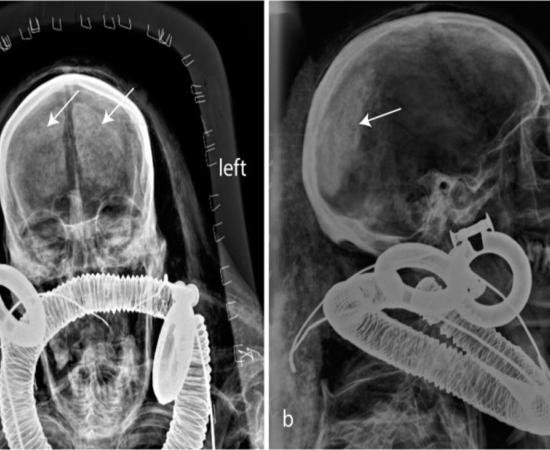 Kha's head in X-ray with a rich gold collar, gold earrings and an opal plate, possibly an amulet. Note the shrunken brain.