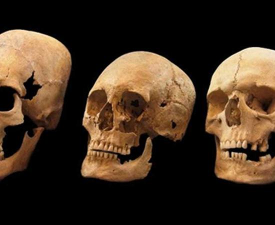 Bavarian skulls on the left and in the middle show signs of deformation; the one on the right is not deformed.