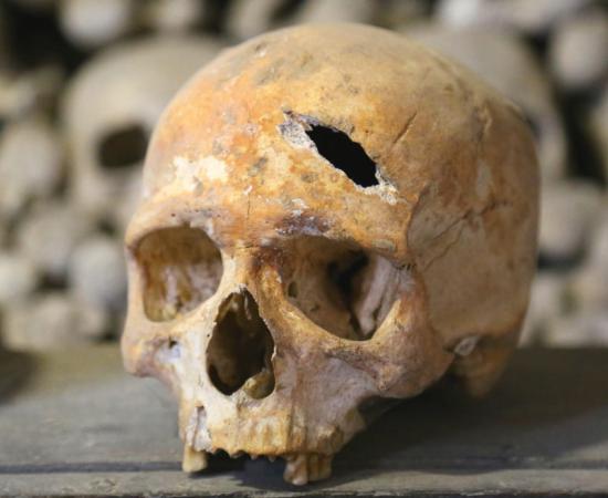 Human skull showing blow to the head 