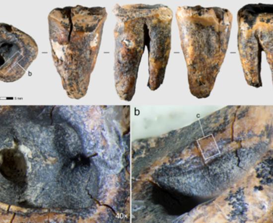 Chagyrskaya 64 molar tooth showing the drilled cavity evidence of Neanderthal Dentistry