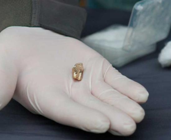 This lower jaw tooth of an early human species, from roughly 1.8 million years ago, discovered at the Orozmani site in southern Georgia, provides more evidence that the first humans left Africa and wandered northeast. Source: Municipality Of Dmanisi