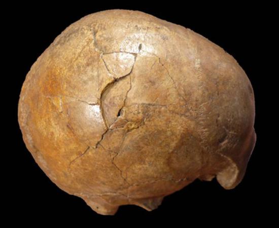 Right lateral view of the Cioclovina calvaria exhibiting a large depressed fracture.      Source: Kranoti et al / Plos One