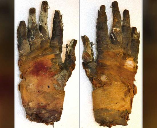 Photograph of human hand that was imaged shows palmar (left) and dorsal (right) views. 