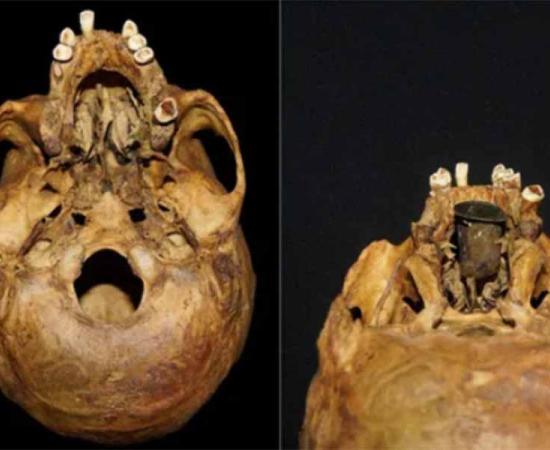 The skull of the man found in Poland from behind. On the left the absence of a hard palate can be clearly seen. The photograph on the right shows how the gold prosthesis was fitted. Source: Anna Spinek; © 2024 Elsevier Ltd / Live Science.