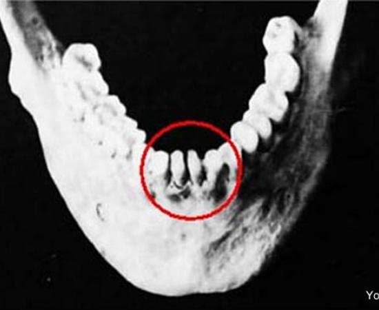 Qiang people vertically grown teeth