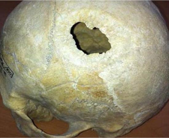 Skull of male with trepanation, who had a hereditary deformation of the skull