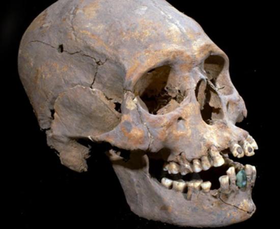 The elongated skull with stone encrusted teeth found in Teotihuacan, Mexico. 