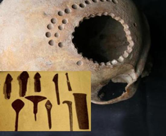 Main: An ancient skull found in Peru with evidence of surgical intervention. Credit: Danielle Kurin. Inset: 4,000-year-old “scalpels” 