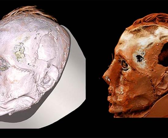 A new CT scan of the Tashtyk death mask has uncovered the face of the ancient Tashtyk man, revealing he had a scar on his face from a wound stitched up after his death. Source: ©The State Hermitage Museum / The Siberian Times