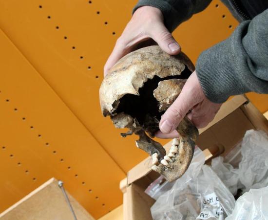 The skull of a young girl who suffered from syphilis; she would have been a candidate for treatment with mercury in the Middle Ages.