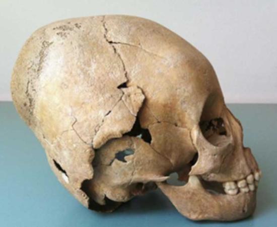 Example of a modified skull