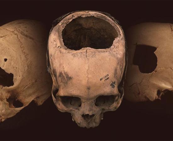 Ancient skulls bearing evidence of trephination - a telltale hole surgically cut into the cranium - found in Peru.             Source: University of Miami