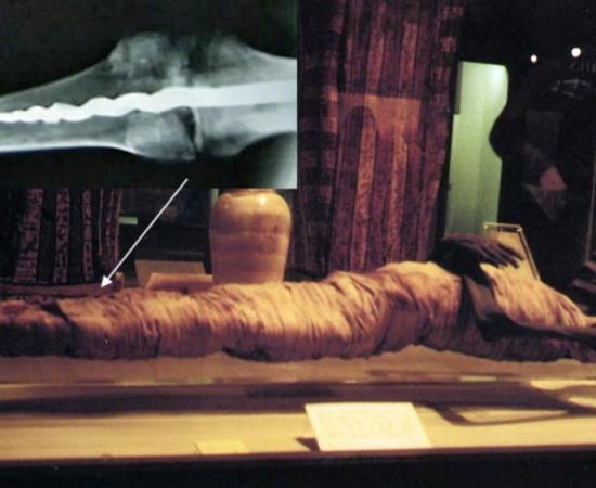 Usermontu's Knee Screw Baffles Experts: 2,600-Year-Old Medical Marvel 