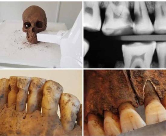 Top, an X-ray image reveals carious lesions on posterior molars. Bottom, a filed hole from the crown of the tooth into the pulp. Source: Carolina Bertilsson and Henrik Lund/PLoS ONE
