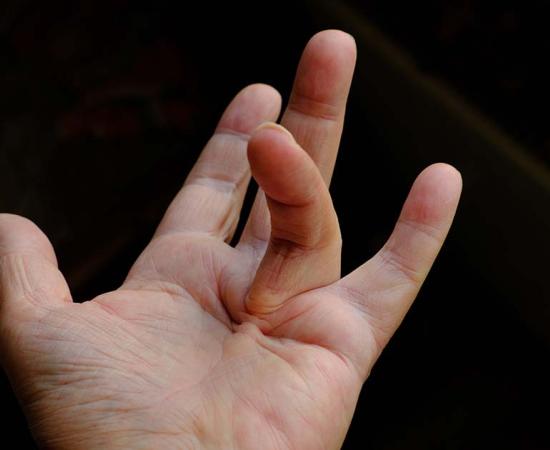 The hand of a person with Viking’s disease, a.k.a. Dupuytren’s contracture, a condition of the hand that can cause some of a person’s fingers to become permanently bent at an angle. Source: Artwell / Adobe Stock 