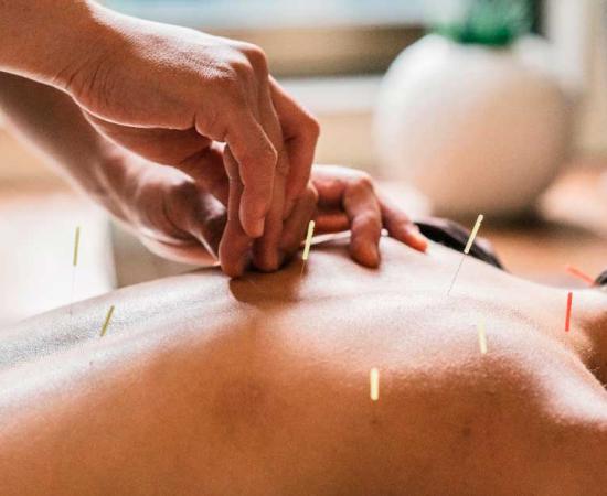 Therapist giving acupuncture to a woman. Source:  juripozzi / Adobe Stock