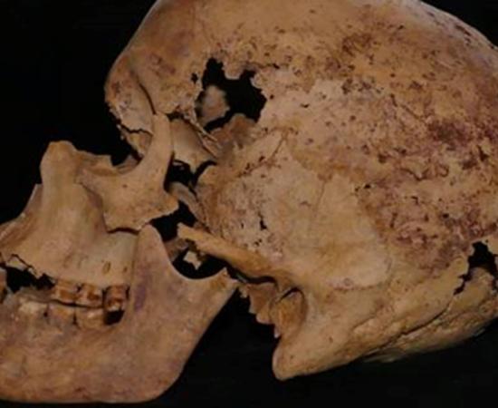 Skull exhibiting evidence of cancer. Source Egyptian Ministry of Antiquities