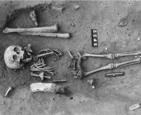 Ancient burial of a child with Down syndrome