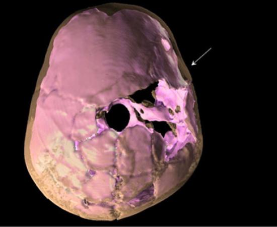 Brain-damaged child 100,000 years old