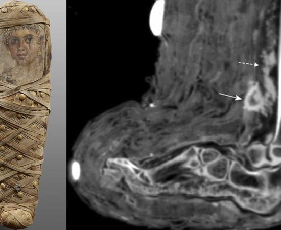On the left, photograph of ancient Egyptian child mummy from Tomb of Aline, discovered in Hawara. On the right, CT scan of soft tissue infection in the lower leg, showing a mass consistent with dried pus. Source: Panzer et. al / International Journal of Paleopathology