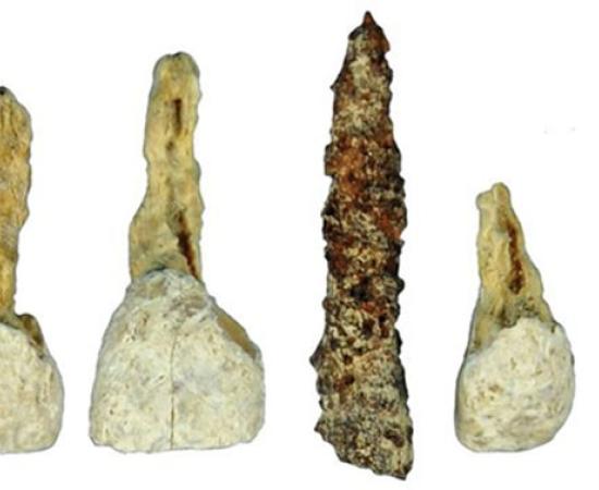 Dental implant in Iron Age burial chamber
