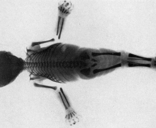 Are Mermaid Myths Inspired by a Rare Medical Condition?