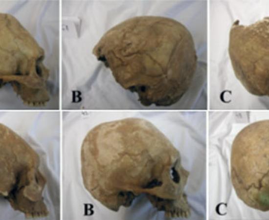 Elongated skulls in the Carpathian Basin