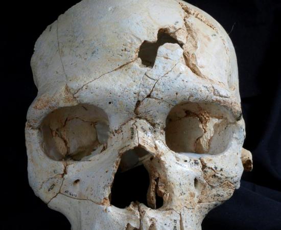 A frontal view of Cranium 17 showing the position of the traumatic events T1 (inferior) and T2 (superior). 