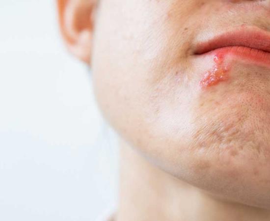 Study has found that human herpes was spread by kissing throughout history. Source: boyloso / Adobe Stock