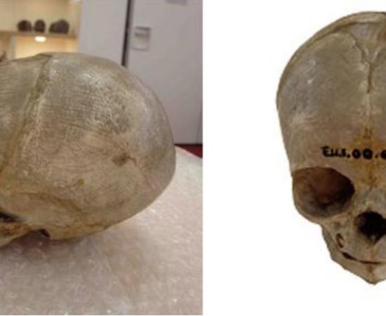 issected foetal skull dating from the 1800s, originally held in the University of Cambridge Anatomy Museum.