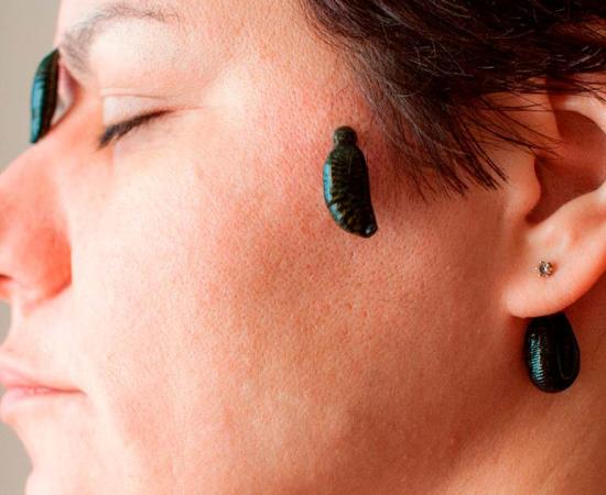 Leech therapy. Source: Natalia Terenteva / Adobe Stock