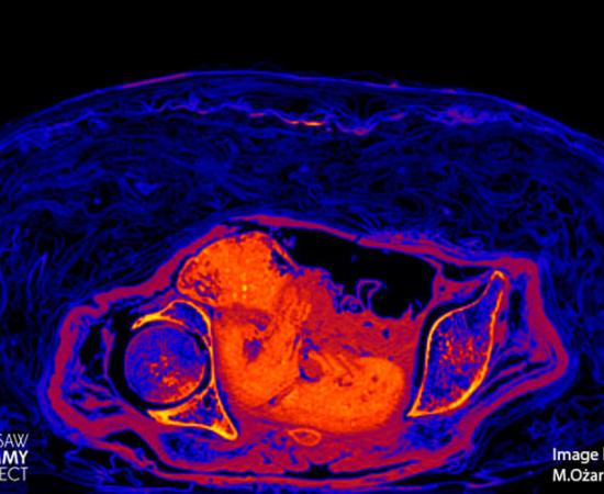 Scan of the mummified fetus discovered within the pregnant mummy. Source: Warsaw Mummy Project 