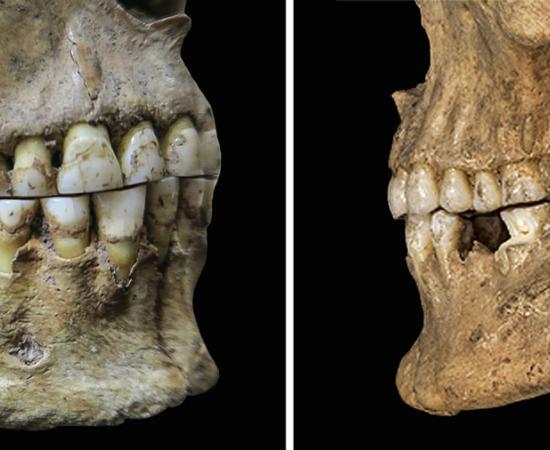 An ancient woman from Romania shows an edgeto-edge bite (left). A Bronze Age man from Austria had a slight overbite (right). Source: D. E. Blasi et. al. / Science 