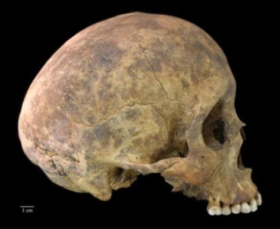 One of two cases of healed blows to the cranium from the Playa Venado excavations. 	Source: Nicole Smith-Guzmán, STRI