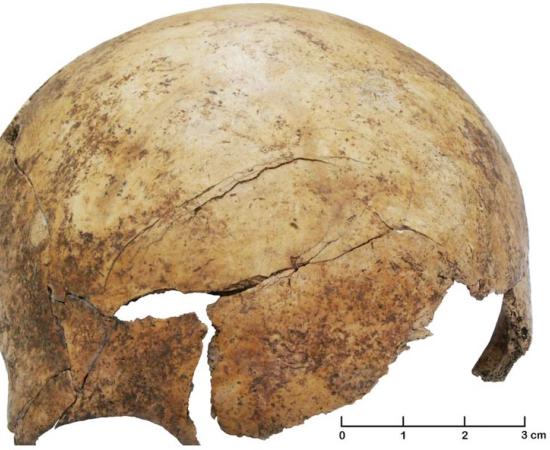 Profound cranial injuries on the frontal skull bone of a child approximately 8 years old. Other such injuries are evidence of a prehistoric massacre or torture at a mass grave at Schoeneck-Kilianstaedten, near Frankfurt, Germany. 