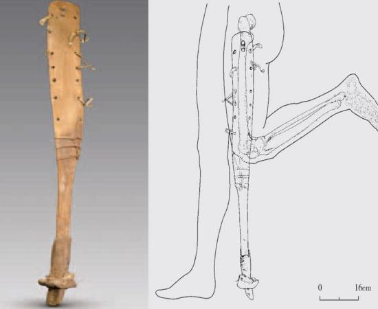 The prosthesis of the man with a fused knee, femur and tibia helped him walked, which would have been difficult for him otherwise. 