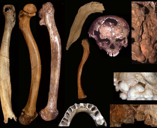 Examples of developmental skeletal abnormalities in Pleistocene people. Left to right: the Tianyuan 1, Sunghir 3 and Dolní V stonice 15 abnormal femora, Center, top to bottom: the Palomas 23 mandibular "flange", the Rochereil 3 cranial lacuna, the long Sunghir 1 clavicle, the Malarnaud 1 incisor agenesis. Right, top to bottom: the Shanidar 1 sacral hiatus, the Pataud 1 polygenesis, and the Dolní V stonice 16 cleft palate.