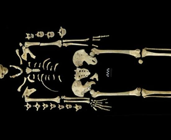 7,000-year-old skeleton of woman may have been a victim of leukemia, making it the oldest case found. 