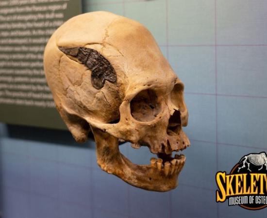 The elongated skull of a Peruvian warrior who underwent skull surgery 2,000 years ago. Source: Museum of Osteology
