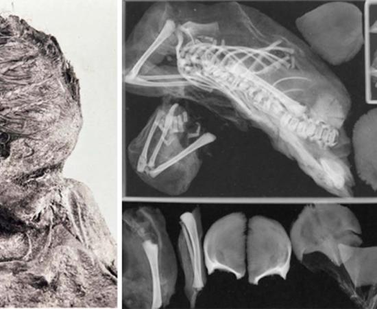 The teenage girl, who was not more than 17 years old, was buried alongside the decapitated baby in a tomb. This led experts to speculate that she might have been unaware of her pregnancy with twins. Right; Rradiograph of mummified fetus found lodged within the teenage girl’s pelvis.  Source: Francine Margolis, David R. Hunt/onlinelibrary.wiley.com
