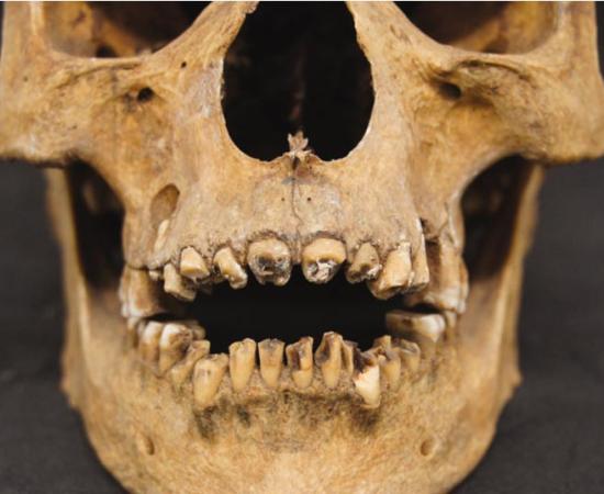 The teeth of a 17th dynasty (circa 1550 BC) mummy had his teeth broken out, probably during the embalming process. This mummy's wrappings were removed in the early 20th century. 