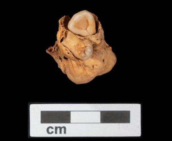 The teratoma tumor, including teeth, which was discovered within the Amarna crypt. Source: A. Deblauwe / Amarna Project