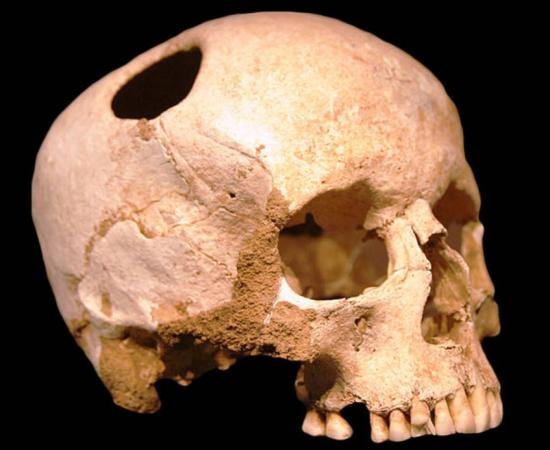 A trepannated skull from Neolithic period