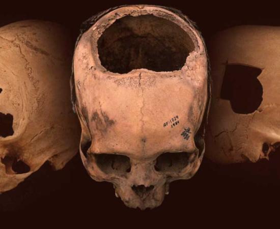 Trepanned skulls have been found worldwide, from Siberia to Turkey to Peru. Pictured: Peruvian trepanation patients. Source: University of Miami