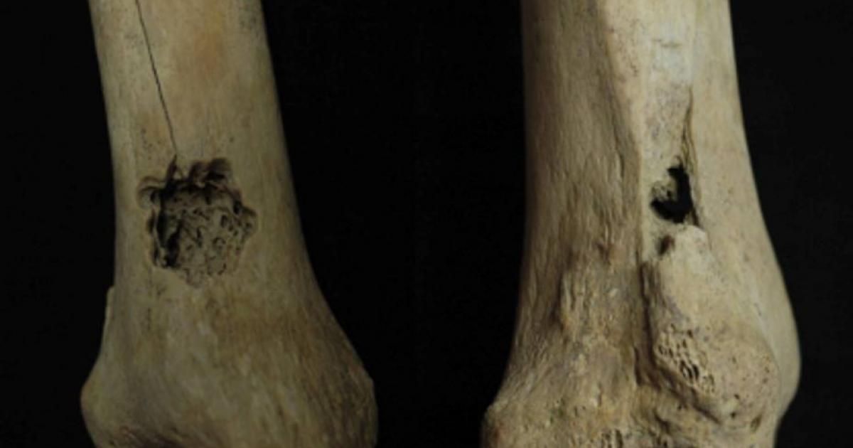 First Ever Evidence for Ancient Bone Surgery found in Peru