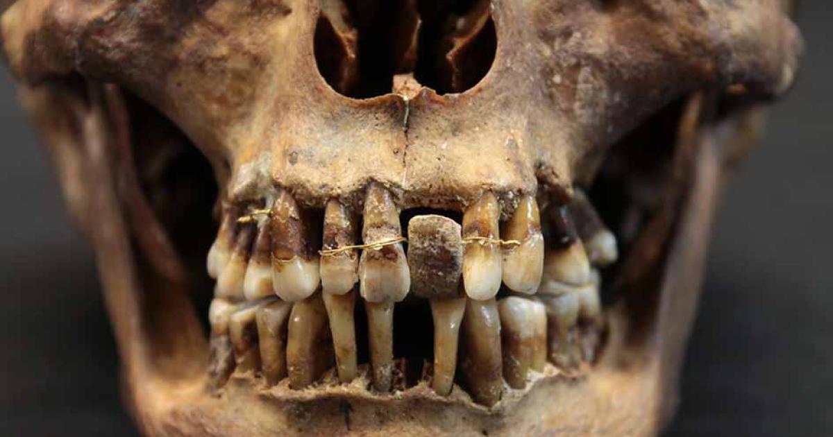 The Skull of Anne d’Alegre, countess of Laval (1565-1619) equipped with hippo bone dental prostheses and gold wire. Source: Rozenn Collator / Inrap
