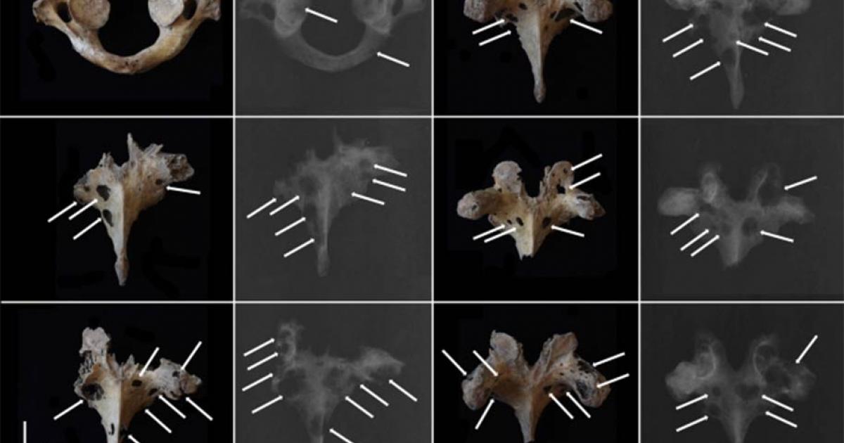Scientists have discovered one of the earliest cases of multiple myeloma, a malignant cancerous tumor, found to date in East Asia within skeletal remains that date back to Bronze Age China. The image shows osteolytic lesions visible on photographs and X-rays of vertebrae. Source: Jenna Dittmar / Science Direct