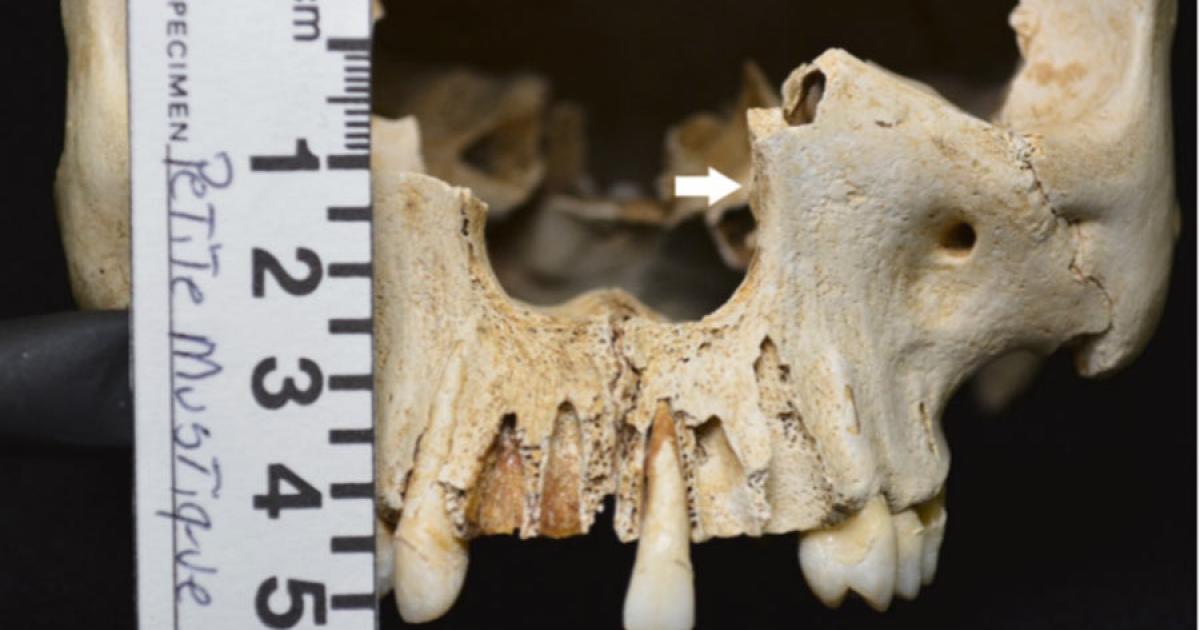 It was this skull, found on the uninhabited island of Petite Mustique in the Caribbean, that was used in the recent leprosy research study.					Source: International Journal of Paleopathology