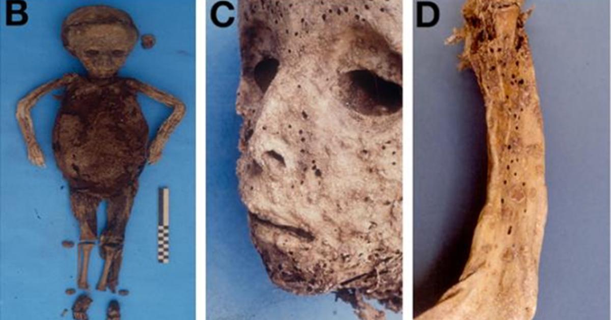 (B) the child’s mummified body prior to the autopsy, (C) the pockmarked face and (D) this rash as evident on the arm. 